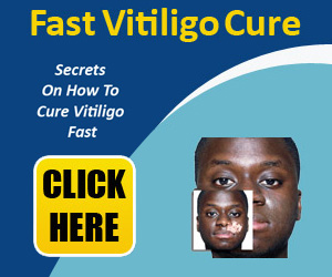 Cure Vitiligo Fast